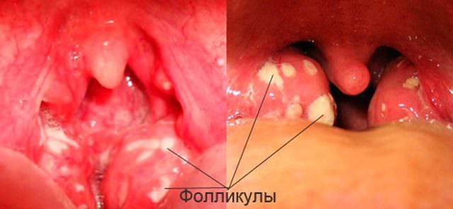 Ганглионит и ганглионеврит, симптомы и лечение крылонебного узла