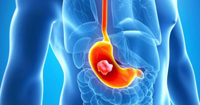 Гастрит хронический с нормальной и повышенной секрецией лечение народными средствами / народная медицина