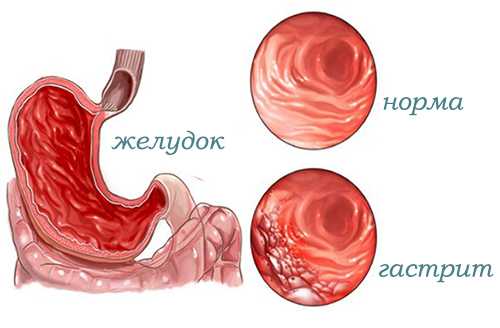 Гастрит с секреторной недостаточностью лечение народными средствами / народная медицина