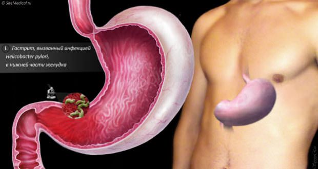 Гастрит с секреторной недостаточностью лечение народными средствами / народная медицина