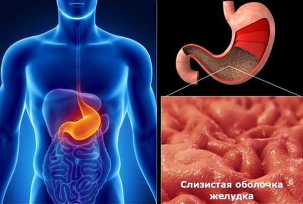 Гастрит желудка: причины, симптомы, лечение