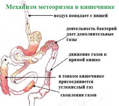 Газы в кишечнике — как избавиться от повышенного газообразования