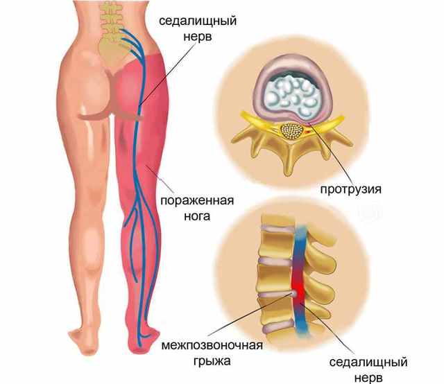 Где находится седалищный нерв у человека и как его лечить, анатомия расположения