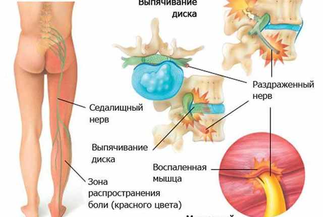 Где находится седалищный нерв у человека и как его лечить, анатомия расположения