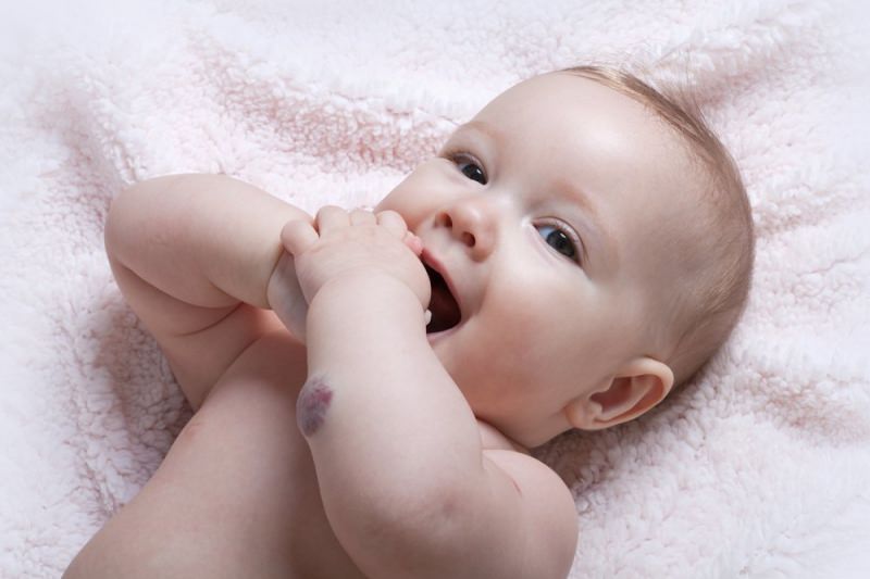 Гемангиома у новорожденных: что такое, 9 причин, симптомы и 8 методов лечения грудничка