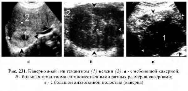 Гемангиомы печени при узи характеризуются фото