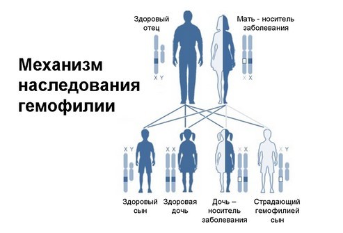 Гемофилия: причины развития, симптомы, осложнения, диагностика, методы лечения гемофилии. 