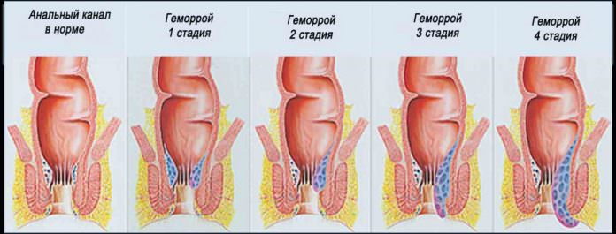 Геморрой лечение народными средствами или как лечить геморрой в домашних условиях / народная медицина