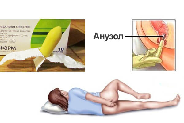 Геморрой &mdash; обзор недорогих и эффективных свечей