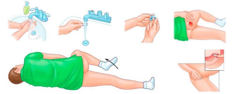 Геморрой &mdash; обзор недорогих и эффективных свечей