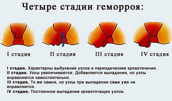 Геморрой &mdash; обзор недорогих и эффективных свечей
