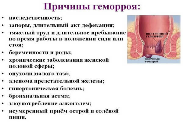 Геморрой: причины, признаки, лечение геморроя в домашних условиях