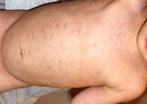 Герпес 6 типа у детей: симптомы и лечение заболевания, мнение доктора комаровского