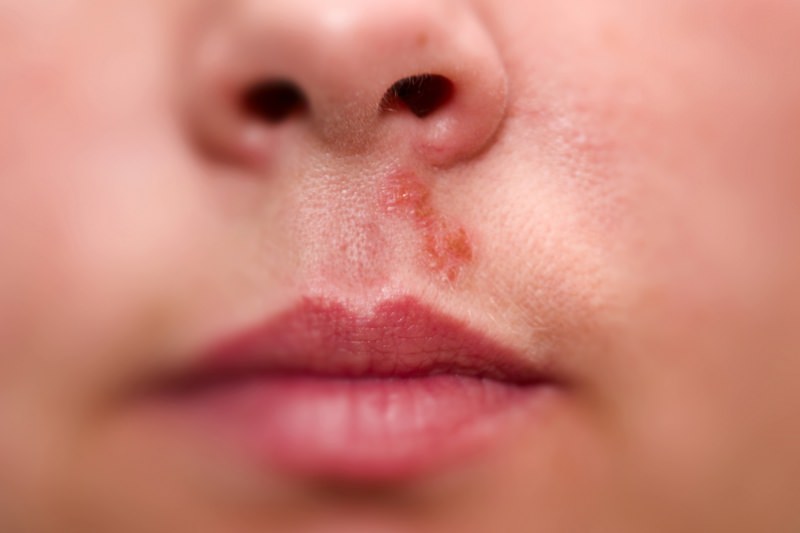 Герпес на носу: причины, лечение, проявления. как лечить?