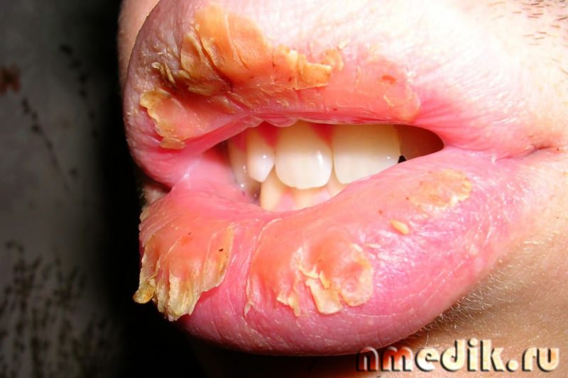 Герпес: признаки и лечение