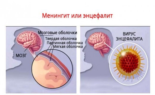 Герпетический энцефалит головного мозга у детей, симптомы новорожденных