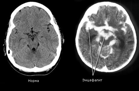 Герпетический энцефалит головного мозга у детей, симптомы новорожденных