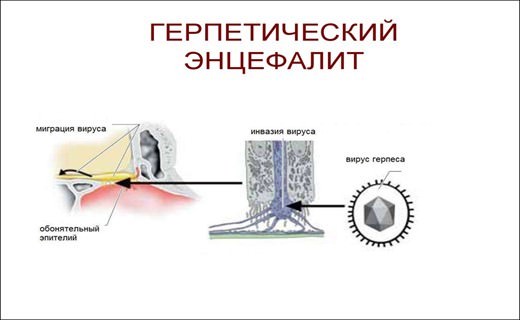 Герпетический энцефалит головного мозга у детей, симптомы новорожденных