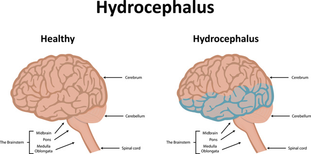 Гидроцефалия головного мозга, симптомы и лечение водянки