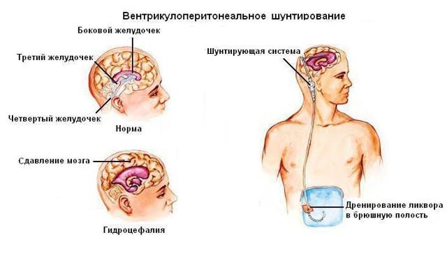 Гидроцефалия головного мозга, симптомы и лечение водянки