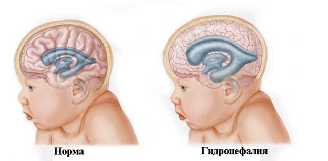 Гидроцефалия головного мозга, симптомы и лечение водянки