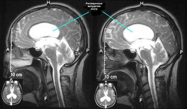 Гидроцефалия головного мозга, симптомы и лечение водянки