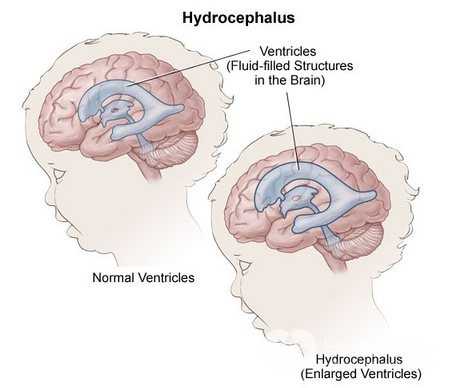Гидроцефалия головного мозга у детей: 4 ведущих метода диагностики и 2 подхода к лечению