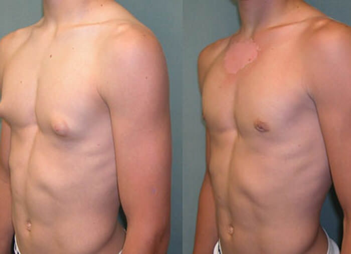 Гинекомастия у мужчин