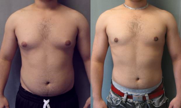 Гинекомастия у мужчин