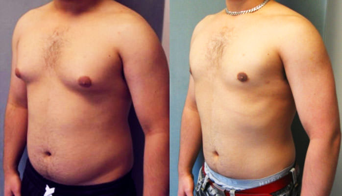 Гинекомастия у мужчин