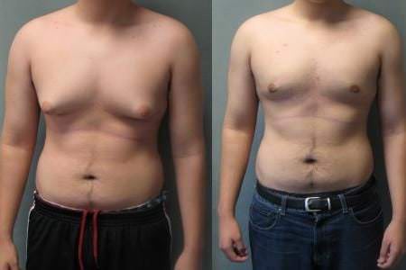 Гинекомастия у мужчин