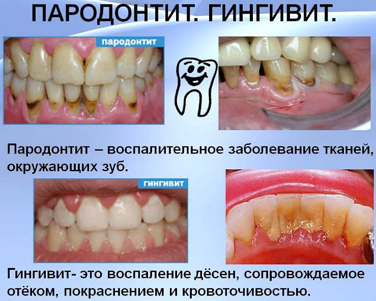 Гингивит &mdash; причины, симптомы, диагностика и лечение, фото десен