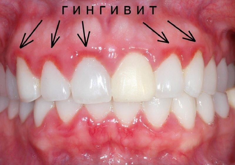 Гингивит &mdash; причины, симптомы, диагностика и лечение, фото десен