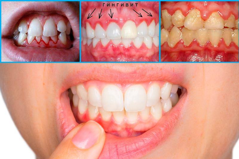 Гингивит &mdash; причины, симптомы, диагностика и лечение, фото десен