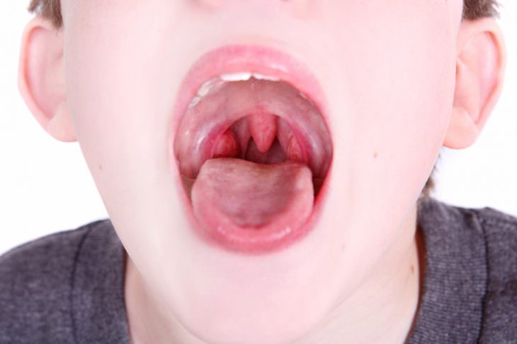 Гипертрофия небных миндалин у детей и взрослых. как лечить?