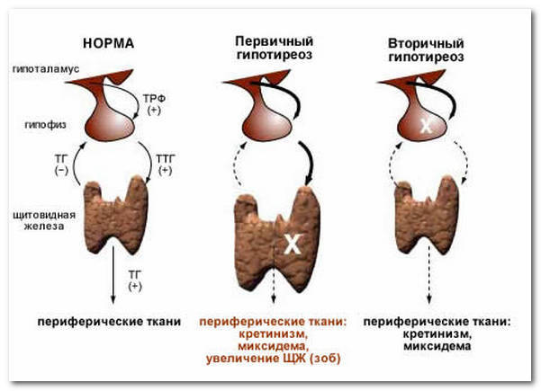 Гипоплазия щитовидной железы: лечение, признаки гипоплазии щитовидной железы у детей и взрослых