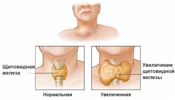 Гипотиреоз у детей: симптомы, лечение, причины увеличения щитовидной железы у ребенка