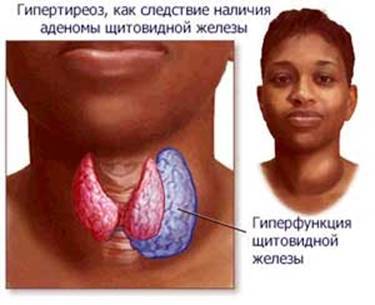 Гипотиреоз у детей: симптомы, лечение, причины увеличения щитовидной железы у ребенка