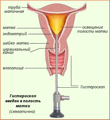 Гистероскопия матки диагностическая, осложнения