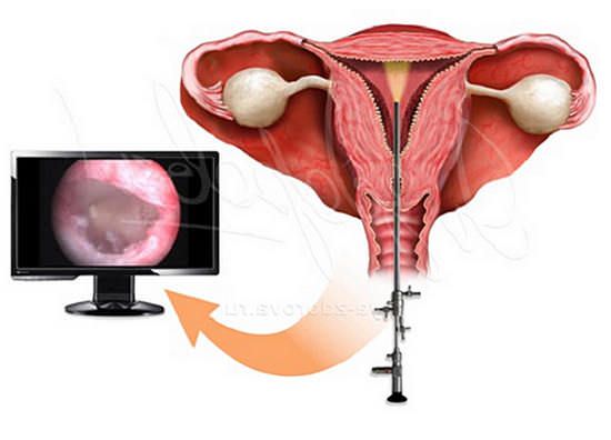 Гистероскопия матки диагностическая, осложнения