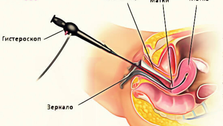 Гистероскопия матки диагностическая, осложнения