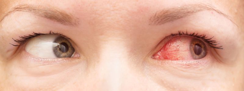 Глазные болезни у детей и взрослых – народные средства, народная медицина, народные рецепты