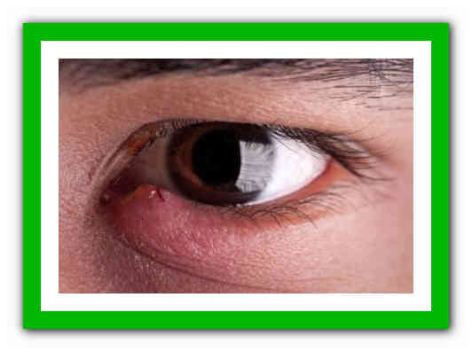 Глазные болезни у детей и взрослых – народные средства, народная медицина, народные рецепты