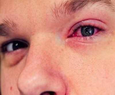 Глазные болезни у детей и взрослых – народные средства, народная медицина, народные рецепты