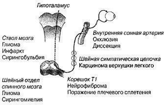 Глазодвигательный паралич отводящего нерва у детей