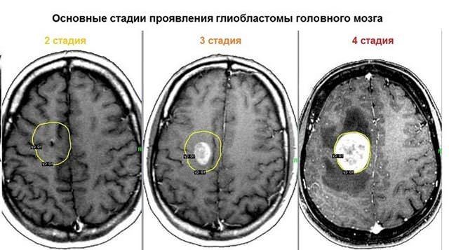 Глиобластома головного мозга мультиформная, срок жизни, можно ли вылечить