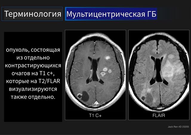 Глиобластома головного мозга мультиформная, срок жизни, можно ли вылечить