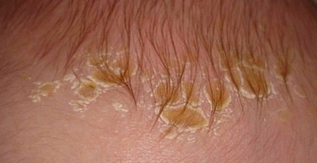 Гнейс у новорожденных, обработка головы при гнейсе, фото