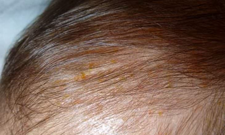 Гнейс у новорожденных, обработка головы при гнейсе, фото