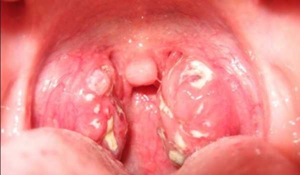 Гной в горле: лечение. как избавиться? причины появления